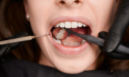 Why You Keep Getting Cavities (Even With Good Habits)